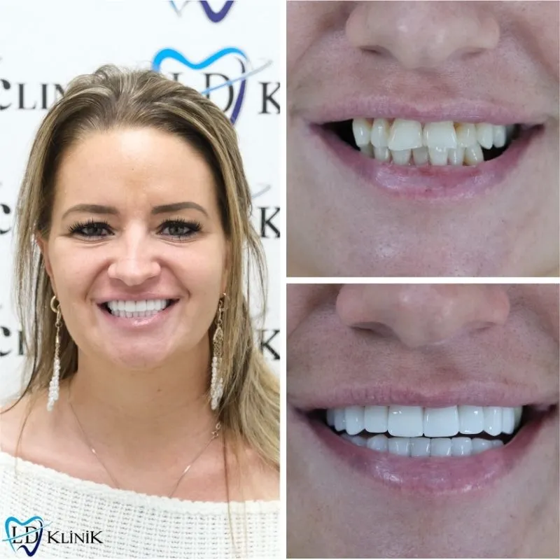 Smile makeover Turkey