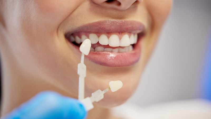 Empress Emax veneers Empress Emax Turkey