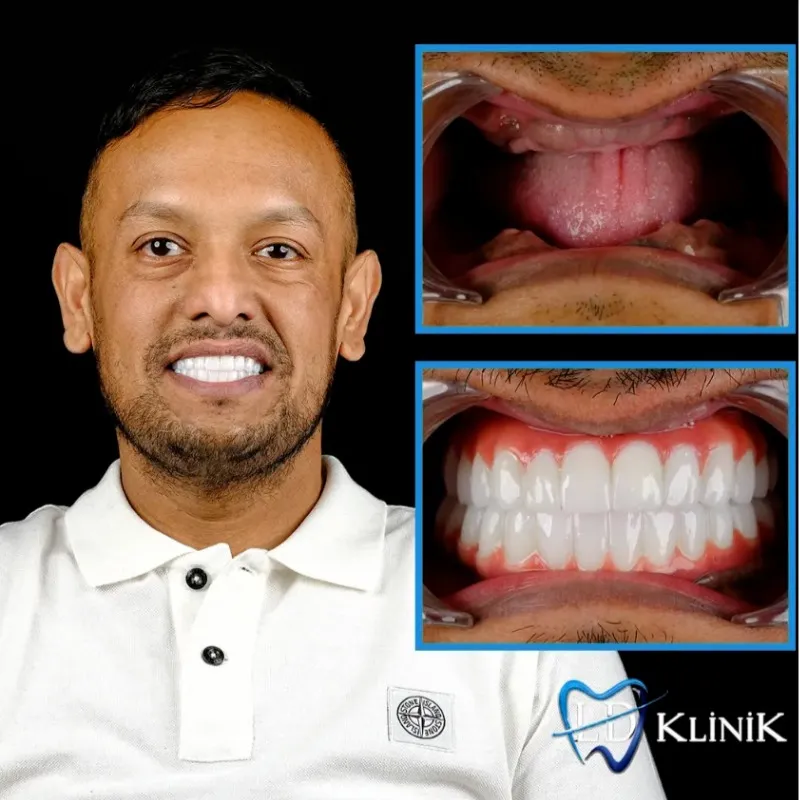 All On 4 dental implants before and after Turkey