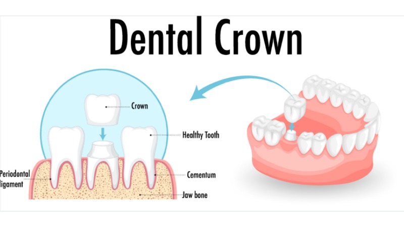 Zirconium crown procedure Turkey