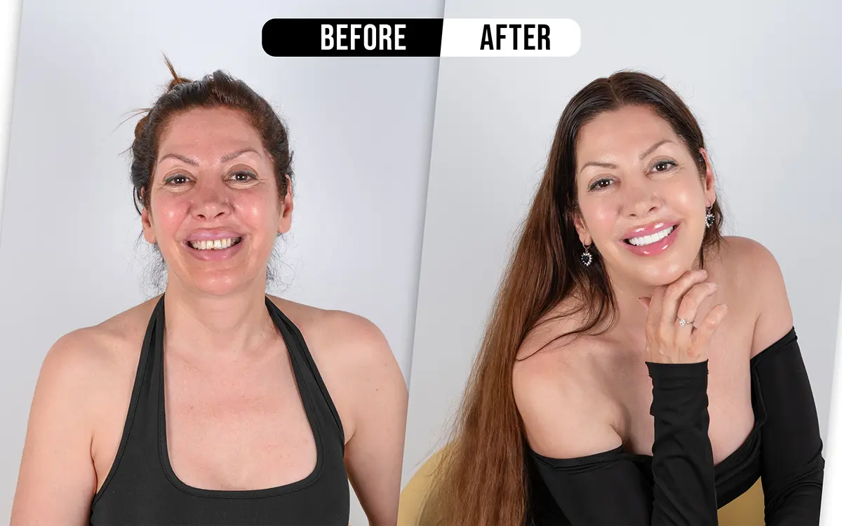 Before and after dental treatment in Turkey