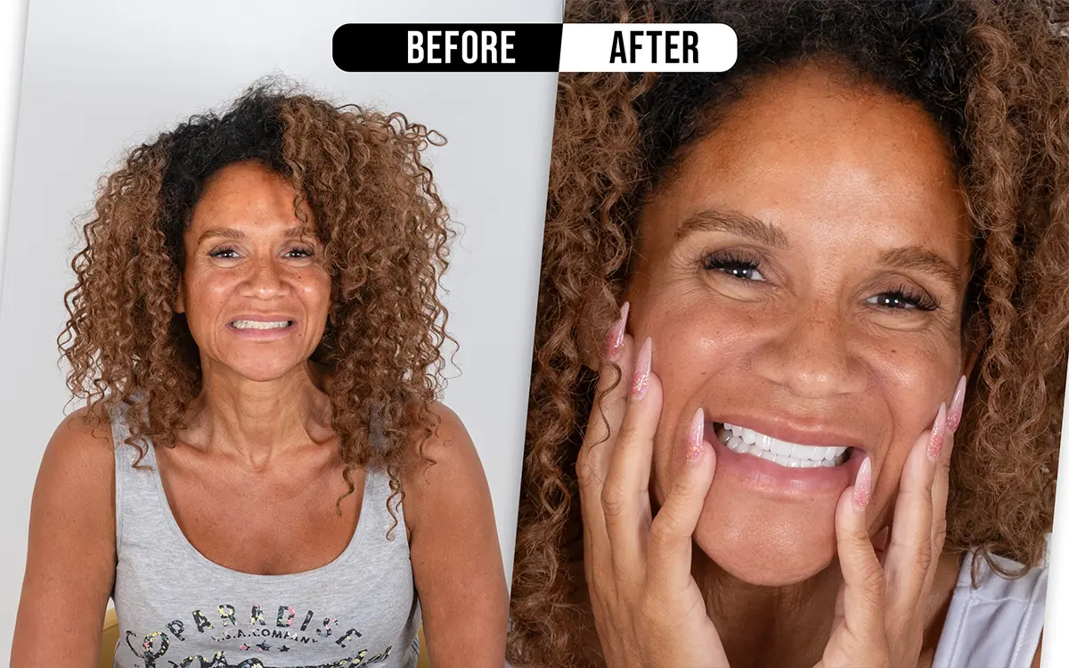 Before and after dental restoration