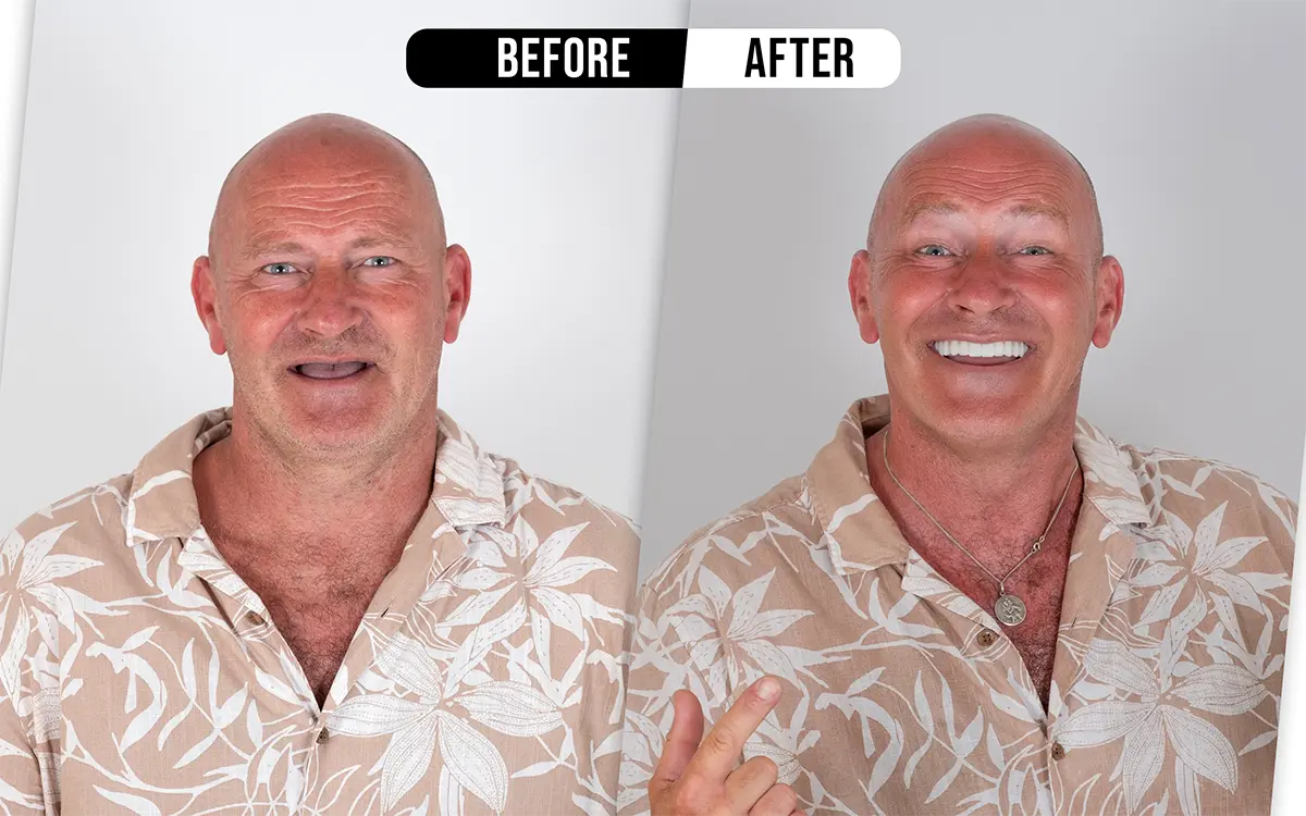 Before and after zirconium crowns